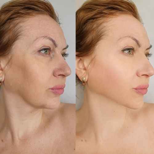 HIFU Non Surgical Facelift Gosport 