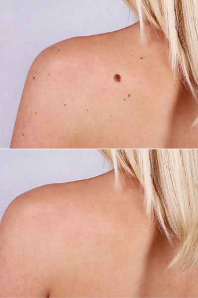 Why Does a Benign Mole Gosport  Occur?
