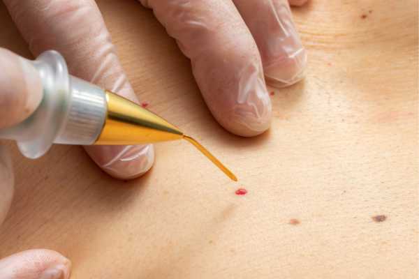 Dermatofibroma Removal Gosport  - How We Remove It