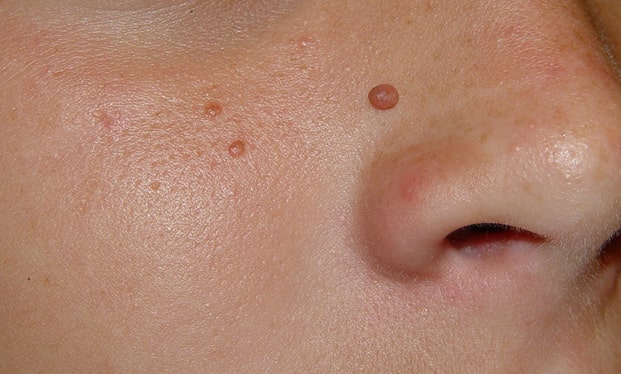 Angiofibromas Gosport  Removal Treatment