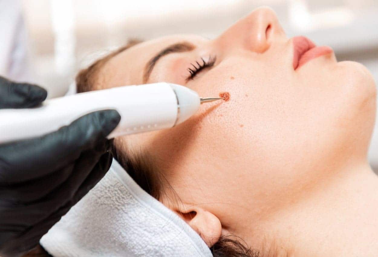 Benefits of Ephelides Treatment Gosport 
