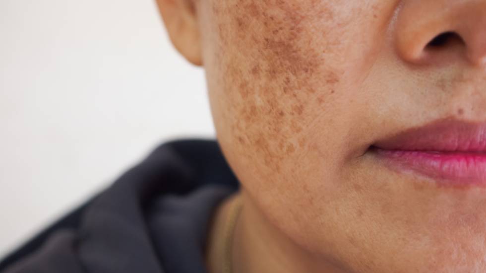 Ephelides Treatment Gosport 