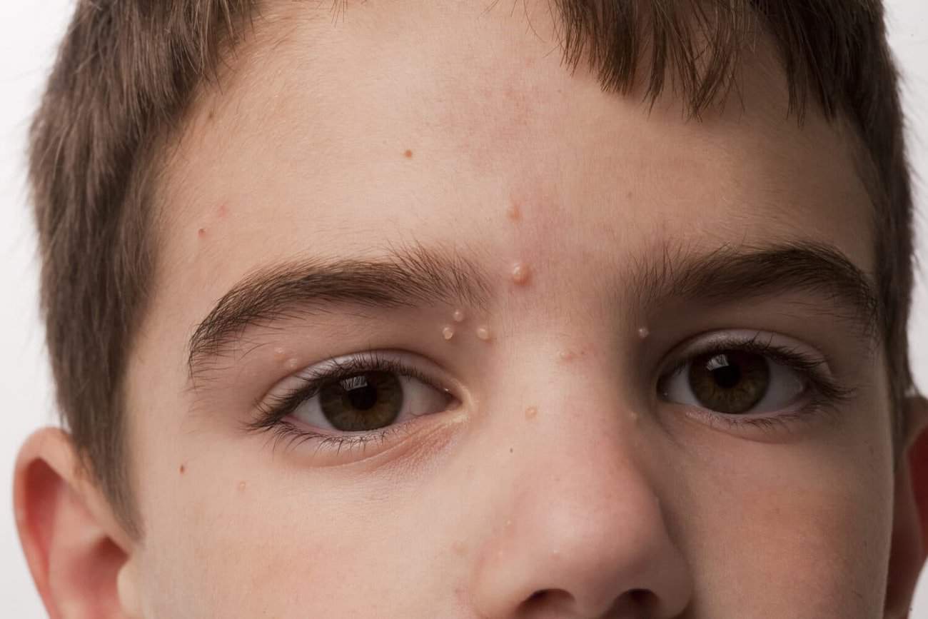 Molluscum Contagiosum Gosport , How We Remove It