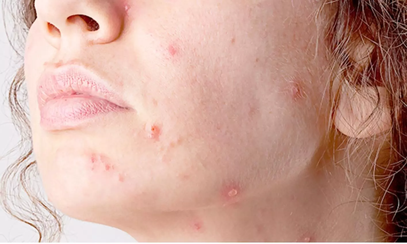 Porokeratosis Gosport , How We Remove It