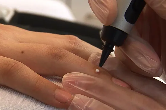 Porokeratosis Treatment Gosport 