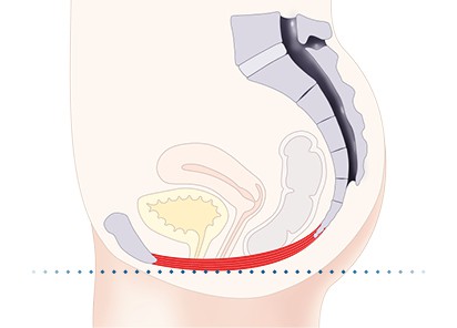 Pelvic-Floor Muscle Repair