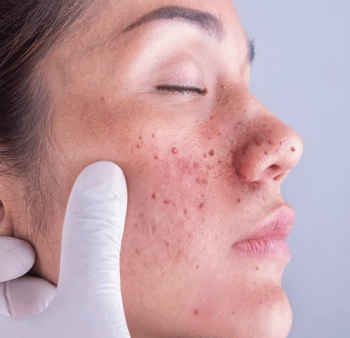 Angiofibroma Treatment Gosport 