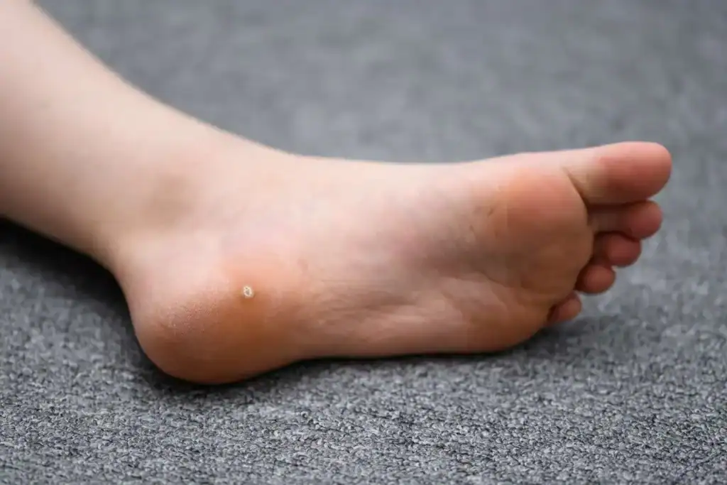 Image of verruca on the bottom of the foot that able to be treated with Cryotherapy Gosport 