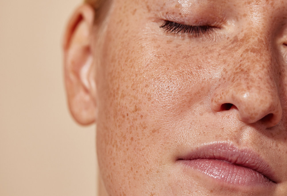 Why Is Lipo 360 Gosport  the Right Place for Ephelides Treatment?