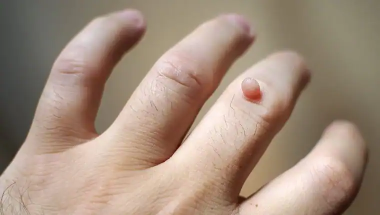 Image of blemish that Cryotherapy Gosport  can remove with Lipo 360.
