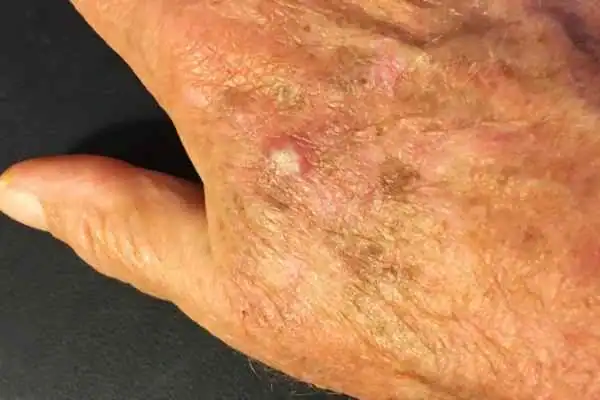 Image of Actinic keratoses Gosport  on a person hand